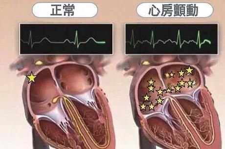 房顫不重視 后果很嚴(yán)重